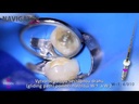 Condensador de guta mecanizada - Gutta condensor - 25mm - Medin