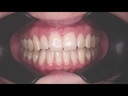 Retractor Básico 702 AUT - Fotodental